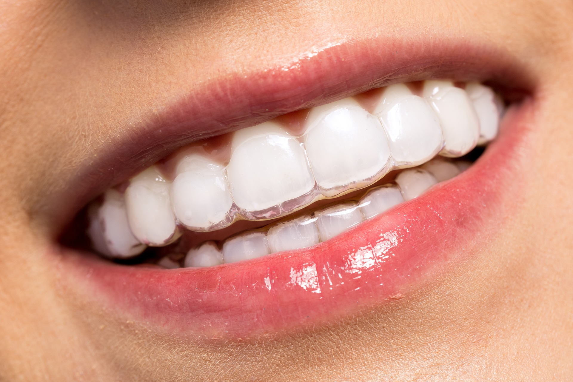 Invisalign Dünya çapında, Ortodonti Alanında Güvenilirliği Kanıtlanmış Bir Tedavi Yöntemidir