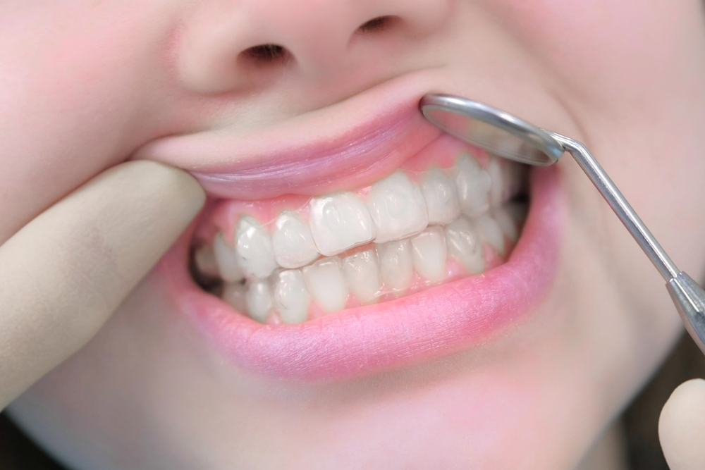 DENTAL TRAVMA HAKKINDA HASTA İÇİN BİLGİ