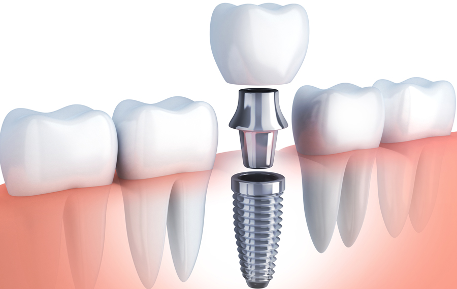 DENTAL IMPLANTLARIN AVANTAJLARI