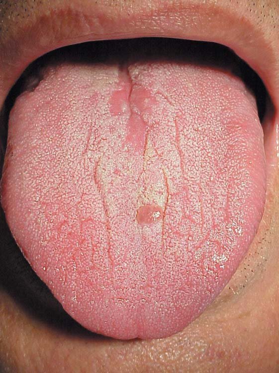 Median Rhomboid Glossitis