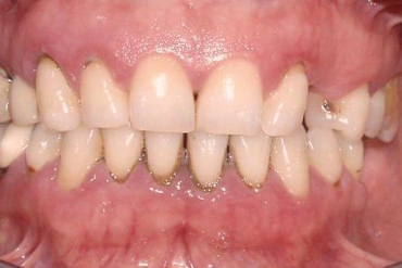 Kronik Periodontitis