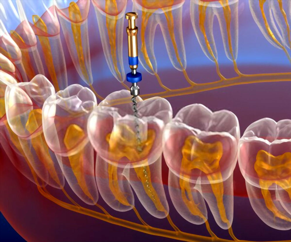 ENDODONTİK LEZYONLARLA İLİŞKİLİ PERİODONTİTİS