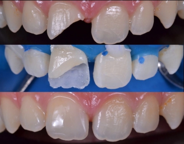 Dental Travmanın Patofizyolojisi ve Sonuçları