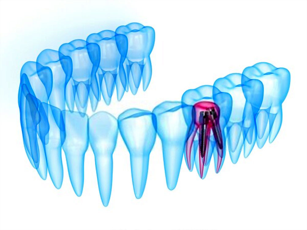 Destekleyici Periodontal Tedavi