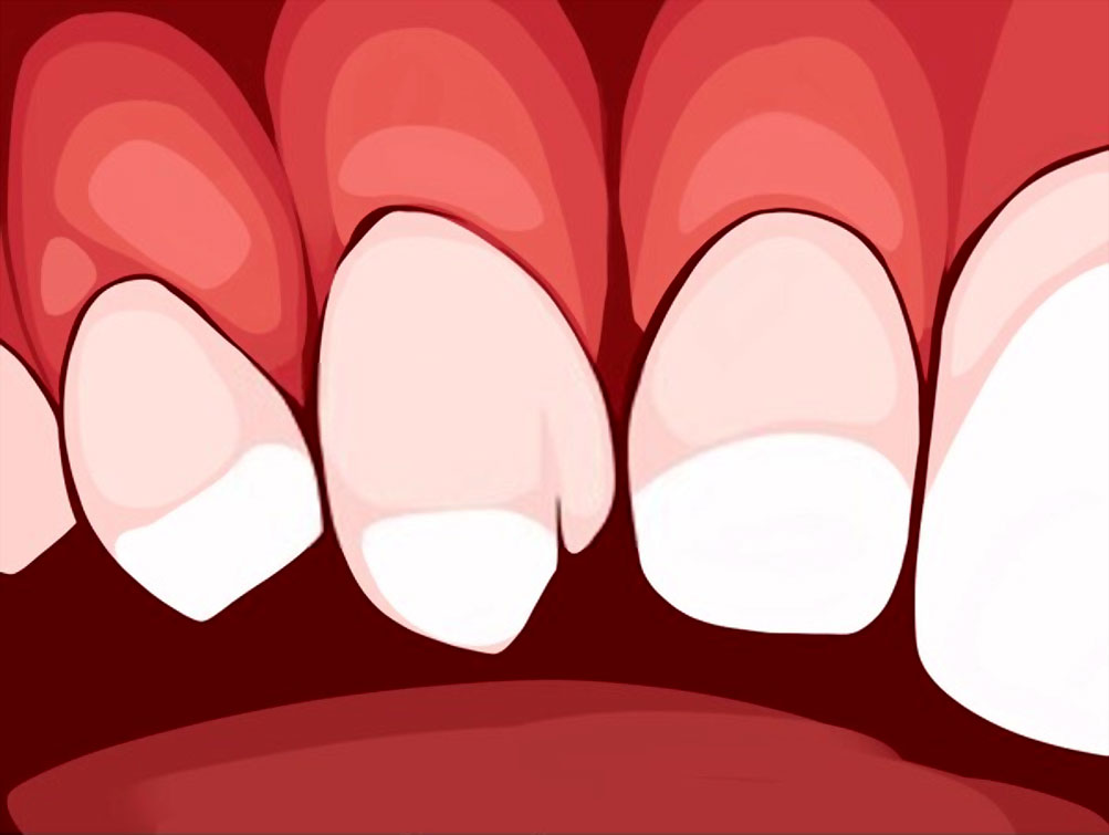 Nekrotizan Periodontal Hastalıklar