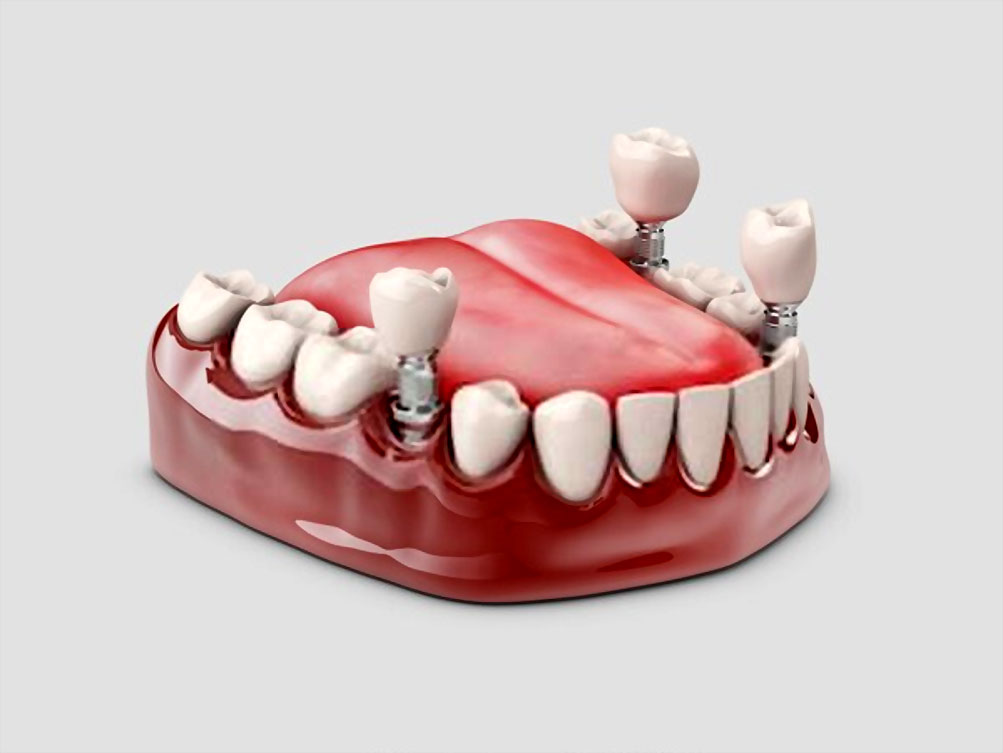 Dentin Bağlayıcı Kuronlar