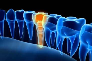 Dental İmplant