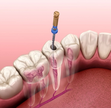 Endodonti (Kanal Tedavisi)