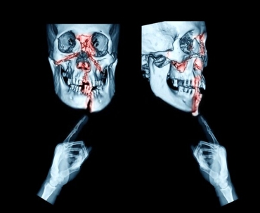 Nazal Ve Malar Kırıklar