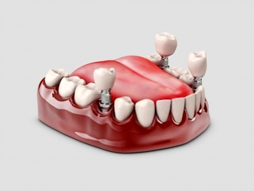 Dentin Bağlayıcı Kuronlar